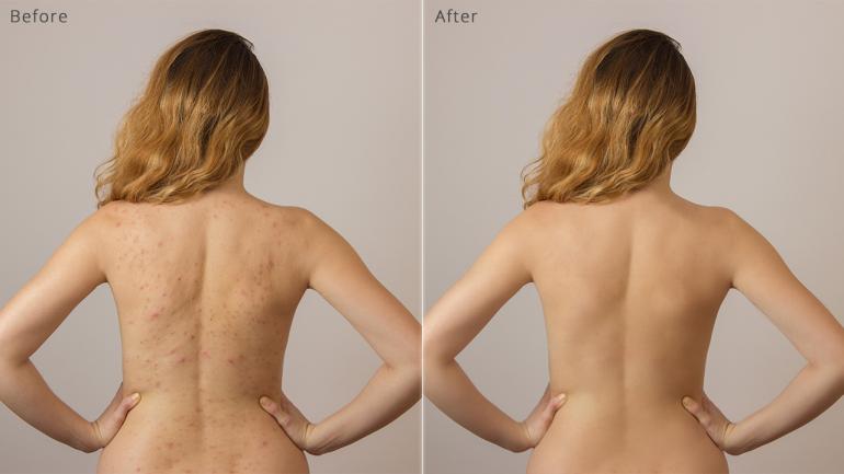 Vor und nach der Haut-Retusche